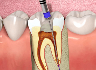 Root Canal Treatment