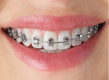 Orthodontic Treatment