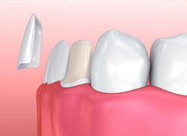 Porcelain Dental Veneers